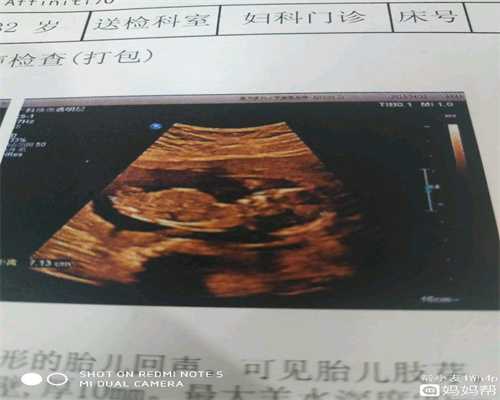 广州民间供卵机构：新生儿需提防三大染色体疾