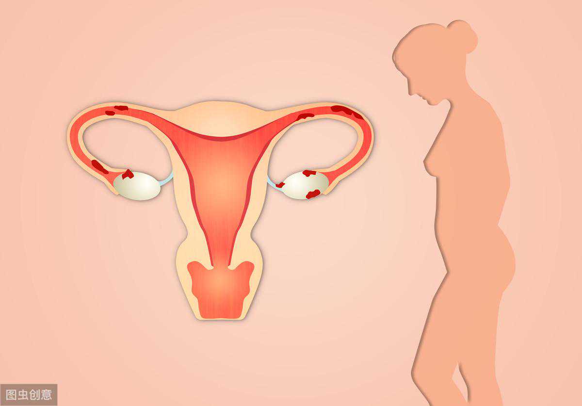 得了子宫肌瘤，我们平时应该怎么注意养护？